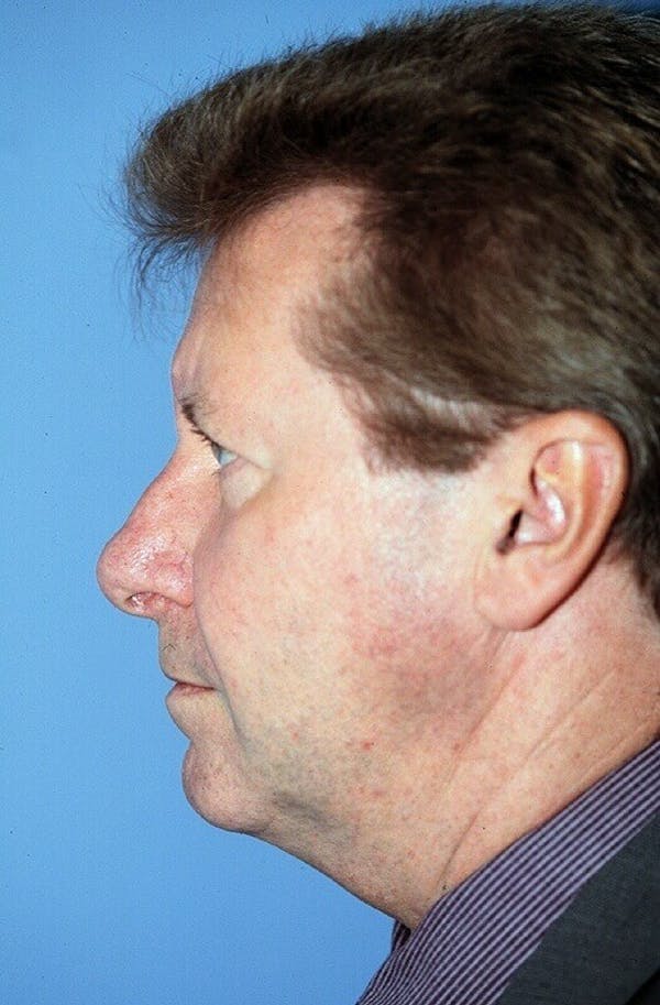 Male Facial Procedures Gallery Before & After Gallery - Patient 6096743 - Image 5