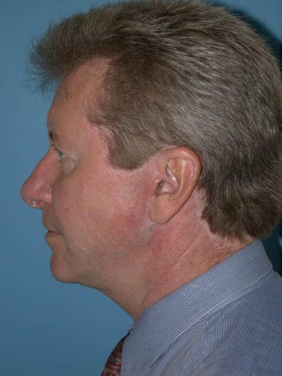 Male Facial Procedures Gallery Before & After Gallery - Patient 6096743 - Image 6