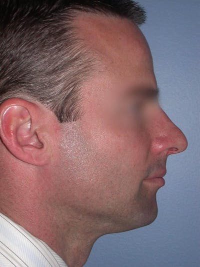 Male Nose Procedures Gallery Before & After Gallery - Patient 6096898 - Image 1