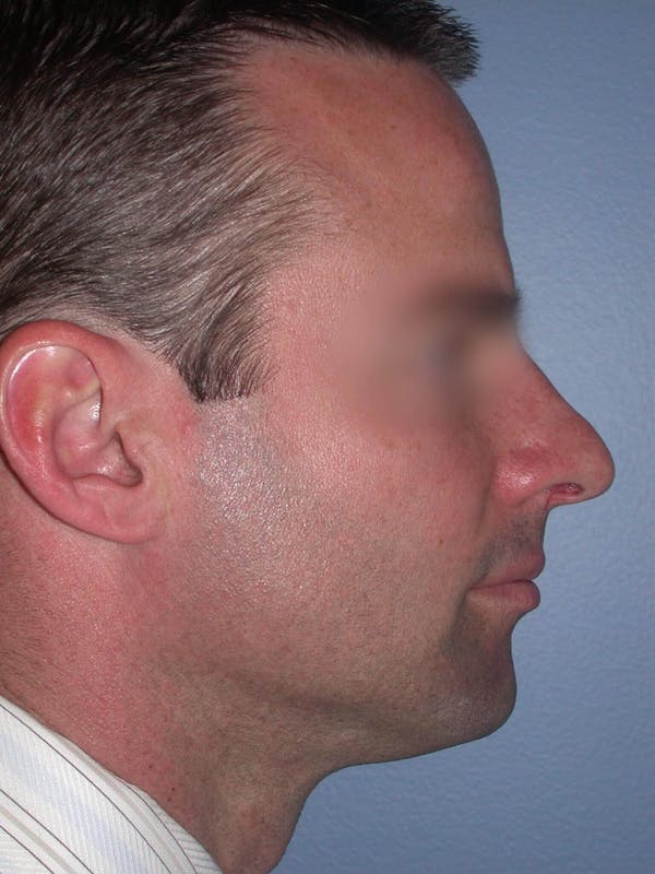 Male Nose Procedures Gallery Before & After Gallery - Patient 6096898 - Image 1