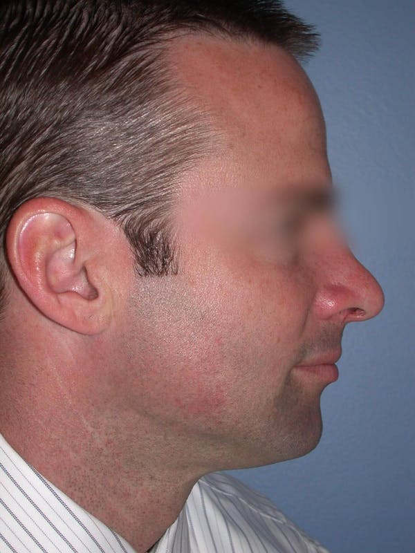 Male Nose Procedures Before & After Gallery - Patient 6096898 - Image 2