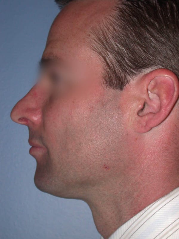 Male Nose Procedures Before & After Gallery - Patient 6096898 - Image 3