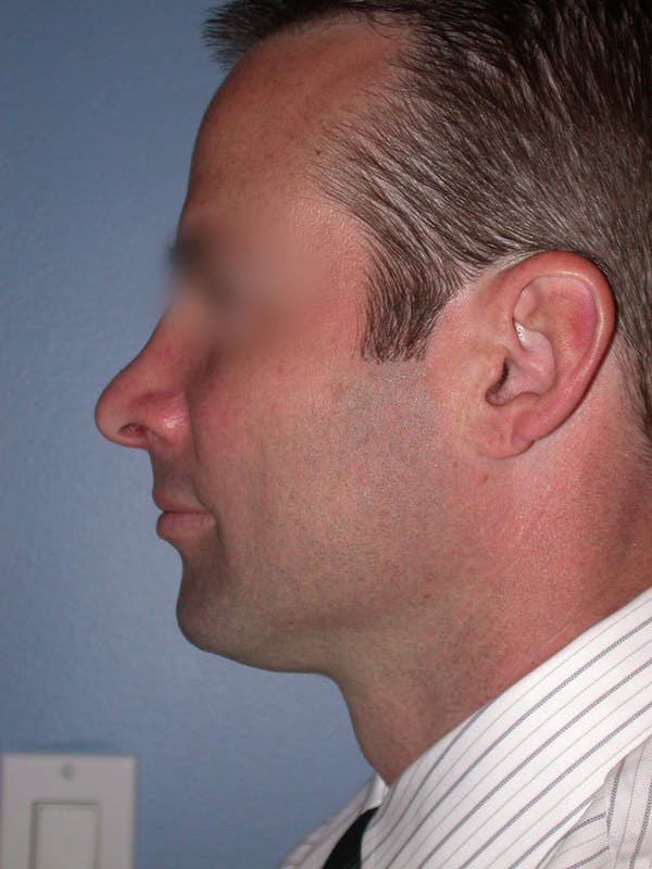 Male Nose Procedures Gallery Before & After Gallery - Patient 6096898 - Image 4