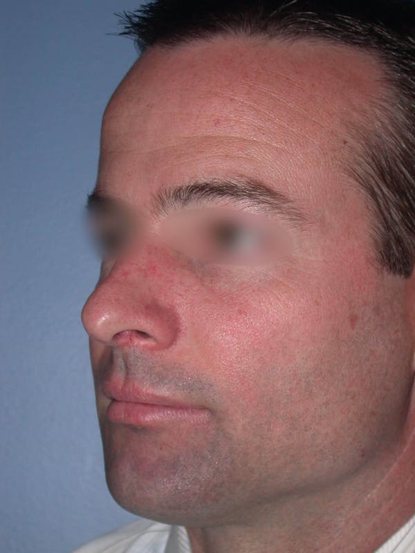 Male Nose Procedures Gallery Before & After Gallery - Patient 6096898 - Image 5