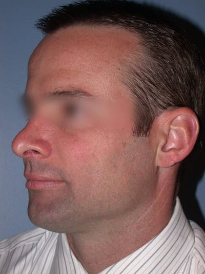 Male Nose Procedures Before & After Gallery - Patient 6096898 - Image 6