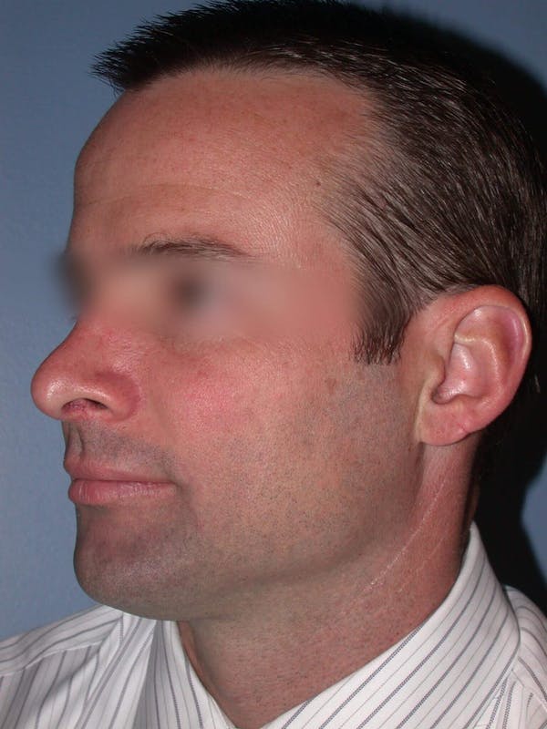Male Nose Procedures Gallery Before & After Gallery - Patient 6096898 - Image 6