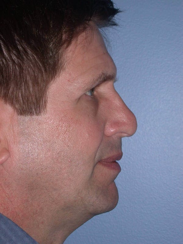 Male Nose Procedures Gallery Before & After Gallery - Patient 6096899 - Image 3