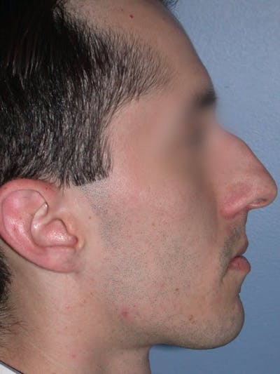 Male Nose Procedures Gallery Before & After Gallery - Patient 6096900 - Image 1