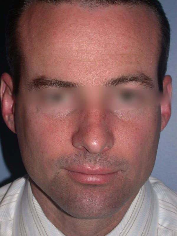 Male Nose Procedures Gallery Before & After Gallery - Patient 6096898 - Image 7