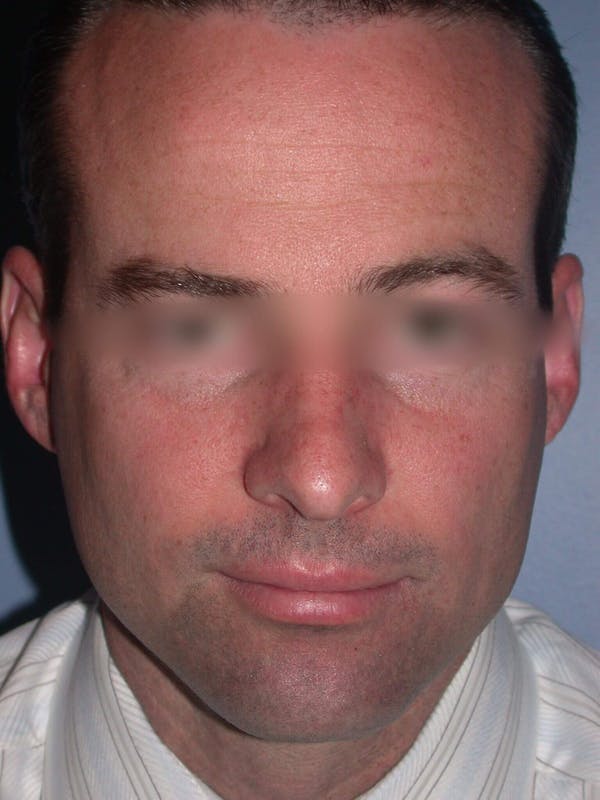 Male Nose Procedures Before & After Gallery - Patient 6096898 - Image 7