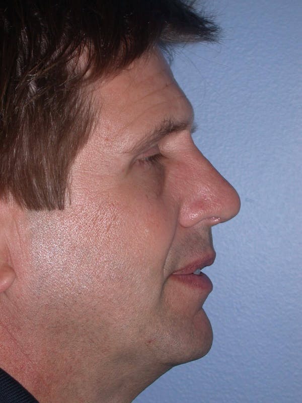 Male Nose Procedures Gallery Before & After Gallery - Patient 6096899 - Image 4