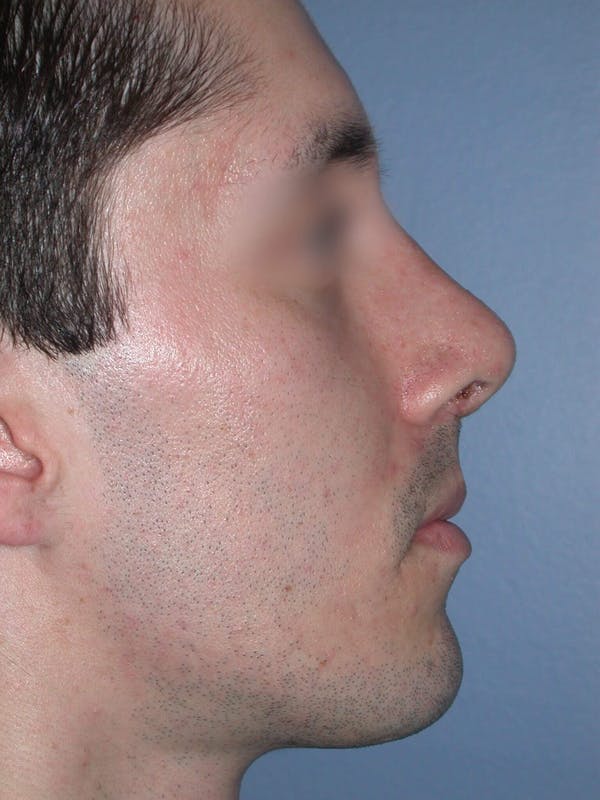 Male Nose Procedures Before & After Gallery - Patient 6096900 - Image 2