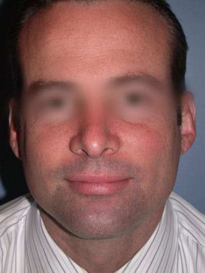 Male Nose Procedures Gallery Before & After Gallery - Patient 6096898 - Image 8