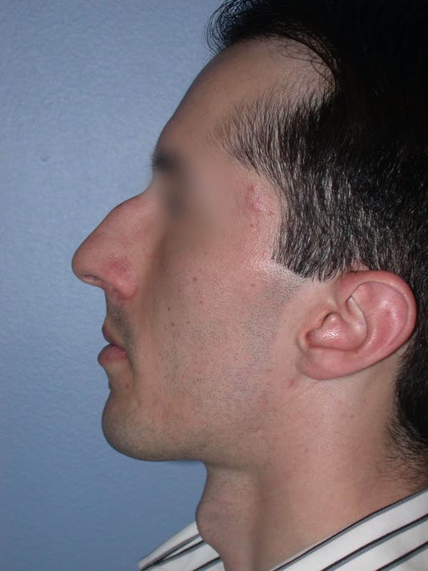 Male Nose Procedures Gallery Before & After Gallery - Patient 6096900 - Image 3