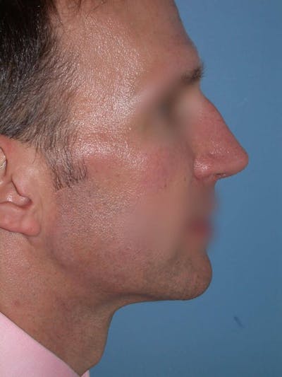 Male Nose Procedures Gallery Before & After Gallery - Patient 6096901 - Image 1