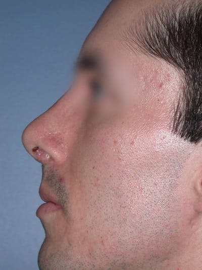 Male Nose Procedures Gallery Before & After Gallery - Patient 6096900 - Image 4