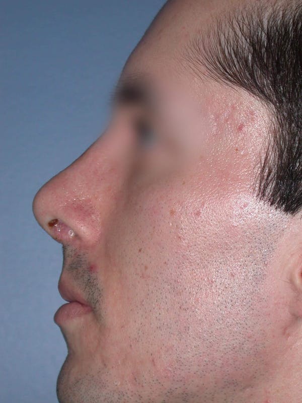 Male Nose Procedures Gallery Before & After Gallery - Patient 6096900 - Image 4