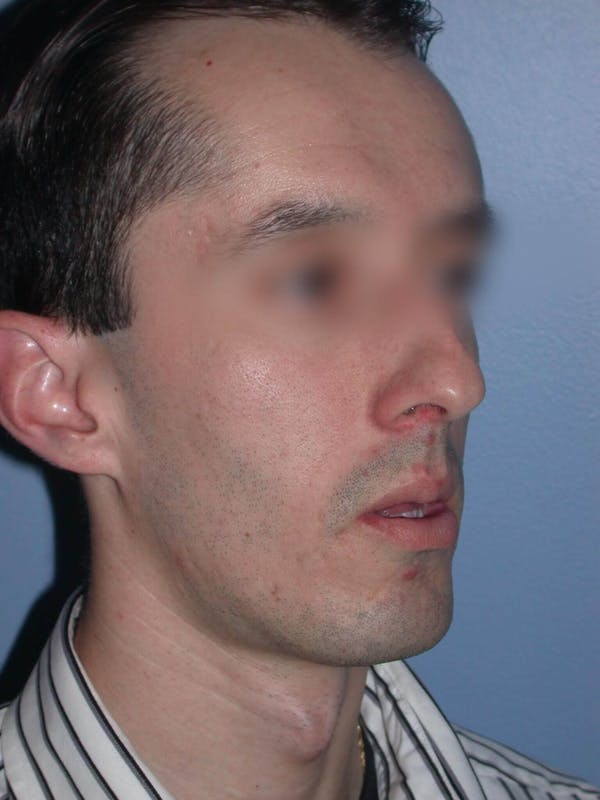 Male Nose Procedures Gallery Before & After Gallery - Patient 6096900 - Image 5