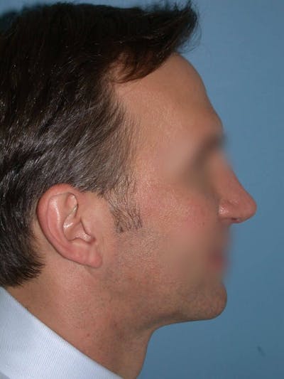 Male Nose Procedures Gallery Before & After Gallery - Patient 6096901 - Image 2