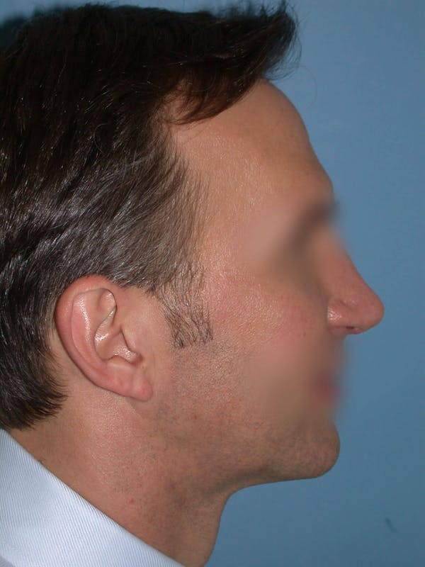 Male Nose Procedures Before & After Gallery - Patient 6096901 - Image 2