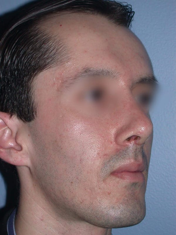 Male Nose Procedures Before & After Gallery - Patient 6096900 - Image 6