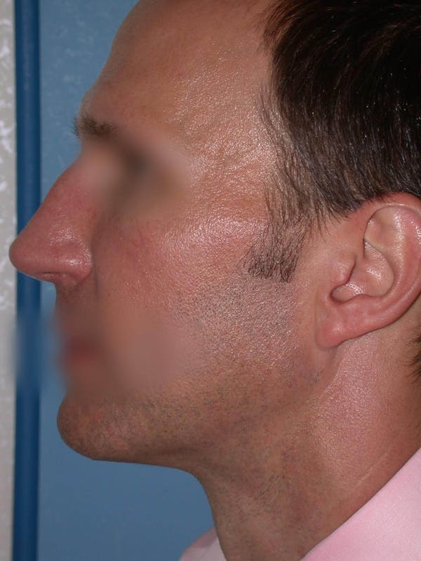 Male Nose Procedures Gallery Before & After Gallery - Patient 6096901 - Image 3