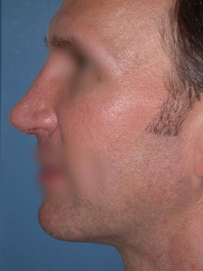 Male Nose Procedures Gallery Before & After Gallery - Patient 6096901 - Image 4