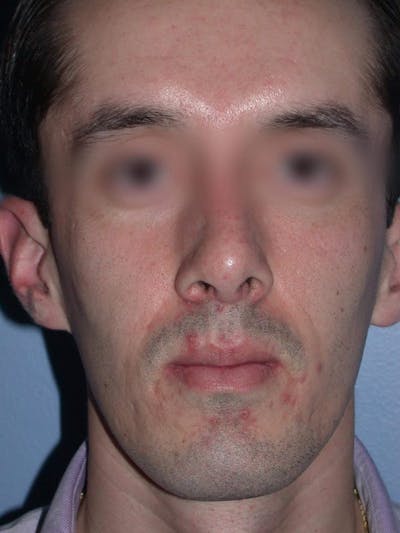 Male Nose Procedures Gallery Before & After Gallery - Patient 6096900 - Image 8