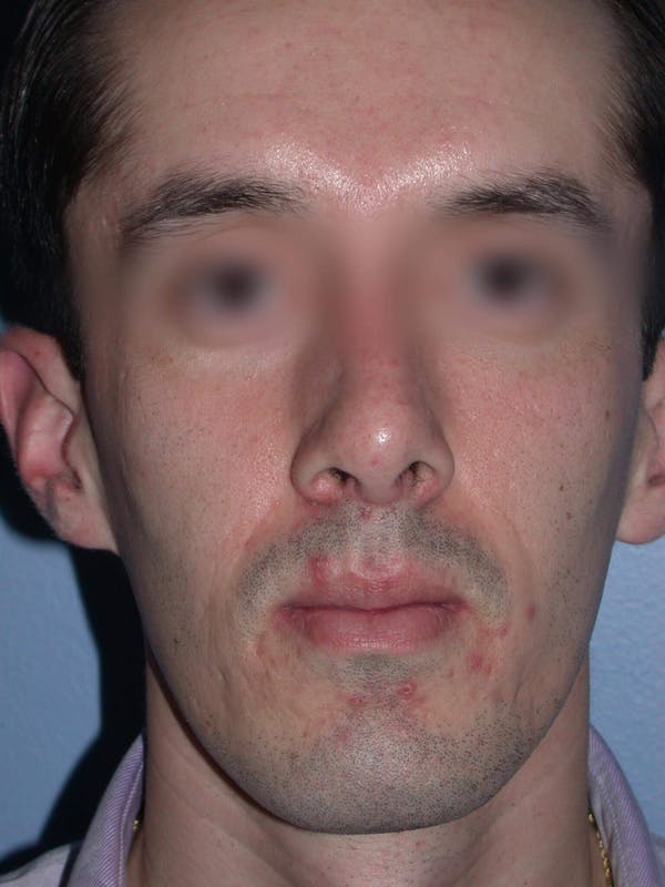 Male Nose Procedures Gallery Before & After Gallery - Patient 6096900 - Image 8