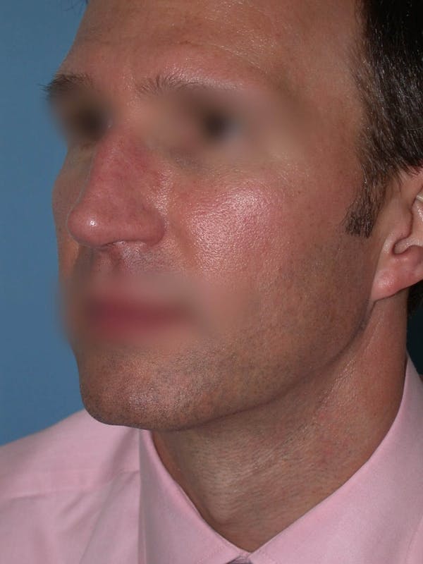 Male Nose Procedures Gallery Before & After Gallery - Patient 6096901 - Image 5