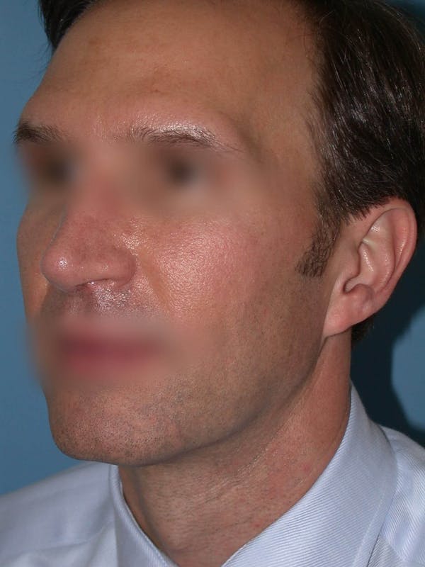 Male Nose Procedures Gallery Before & After Gallery - Patient 6096901 - Image 6