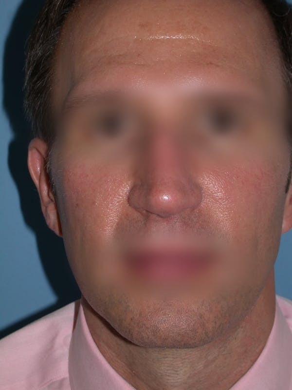 Male Nose Procedures Gallery Before & After Gallery - Patient 6096901 - Image 7