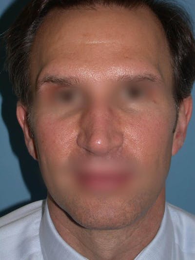 Male Nose Procedures Gallery Before & After Gallery - Patient 6096901 - Image 8