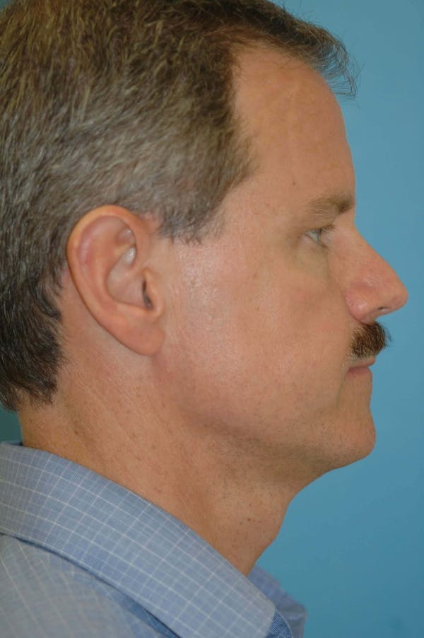 Male Eye Procedures Gallery Before & After Gallery - Patient 6097010 - Image 3