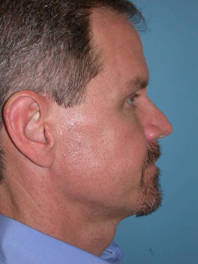 Male Eye Procedures Gallery Before & After Gallery - Patient 6097010 - Image 4