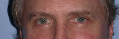 Male Eye Procedures Gallery Before & After Gallery - Patient 6097011 - Image 2