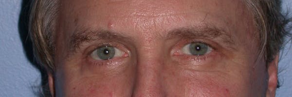 Male Eye Procedures Before & After Gallery - Patient 6097011 - Image 2