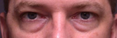 Male Eye Procedures Gallery Before & After Gallery - Patient 6097012 - Image 1