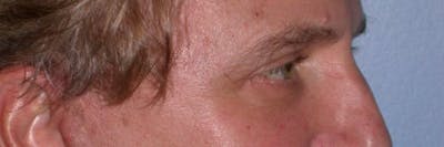 Male Eye Procedures Gallery Before & After Gallery - Patient 6097011 - Image 4