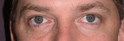 Male Eye Procedures Gallery Before & After Gallery - Patient 6097012 - Image 2