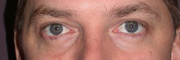 Male Eye Procedures Gallery Before & After Gallery - Patient 6097012 - Image 2