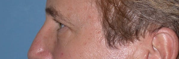 Male Eye Procedures Gallery Before & After Gallery - Patient 6097011 - Image 5