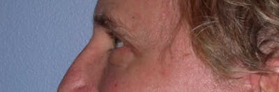 Male Eye Procedures Gallery Before & After Gallery - Patient 6097011 - Image 6