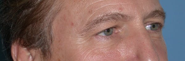 Male Eye Procedures Gallery Before & After Gallery - Patient 6097011 - Image 7