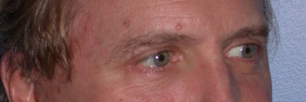 Male Eye Procedures Gallery Before & After Gallery - Patient 6097011 - Image 8