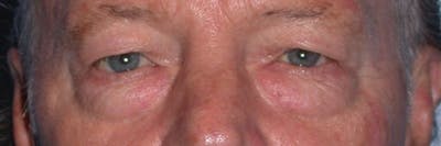 Male Eye Procedures Gallery Before & After Gallery - Patient 6097013 - Image 1