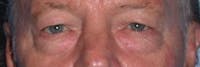 Male Eye Procedures Before & After Gallery - Patient 6097013 - Image 1