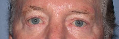 Male Eye Procedures Gallery Before & After Gallery - Patient 6097013 - Image 2