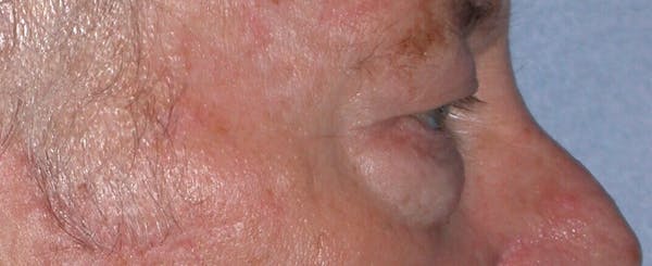 Male Eye Procedures Gallery Before & After Gallery - Patient 6097013 - Image 3