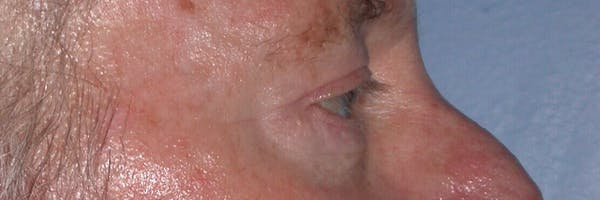 Male Eye Procedures Before & After Gallery - Patient 6097013 - Image 4